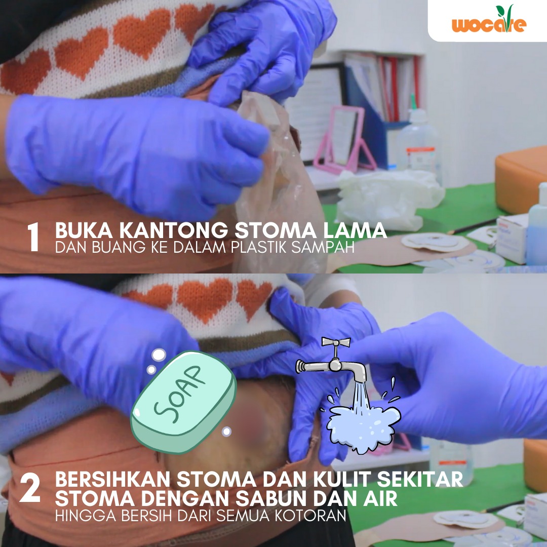 LAYANAN PERAWATAN STOMA GRATIS