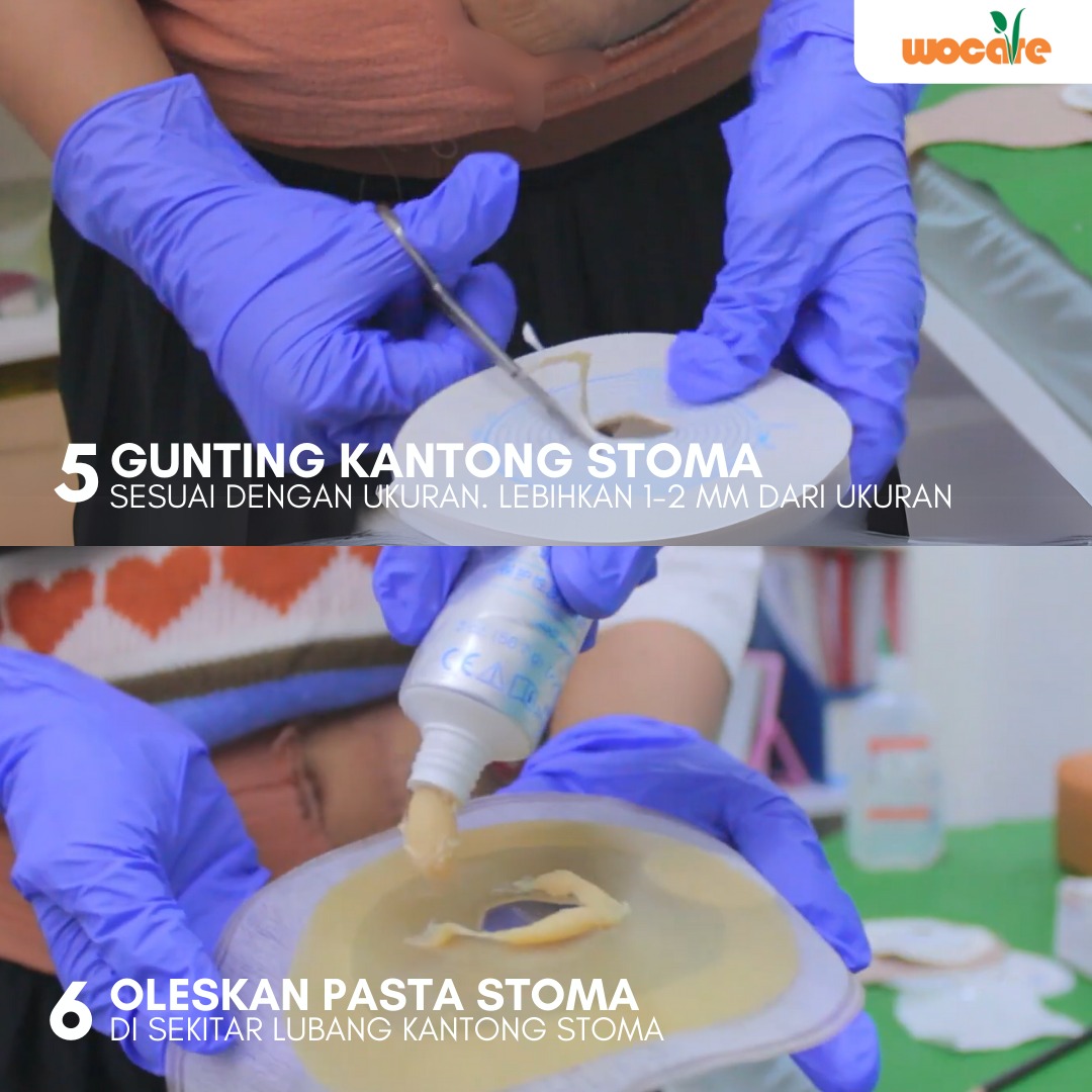 LAYANAN PERAWATAN STOMA GRATIS